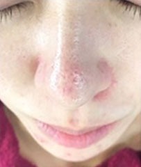 施術1回3週間後